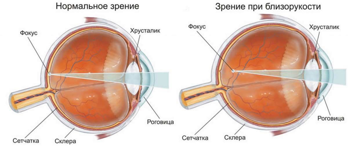 Схема миопии (близорукости) глаза