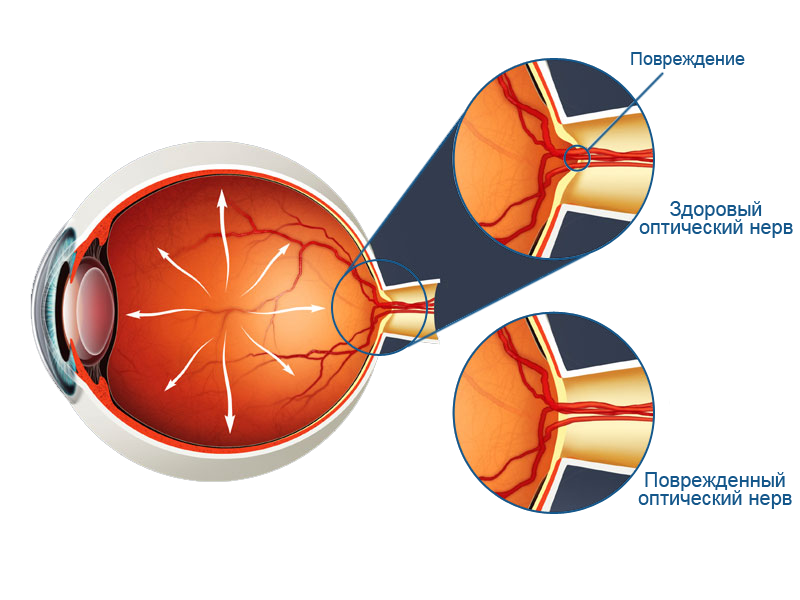 Поврежденный оптический нерв при глаукоме
