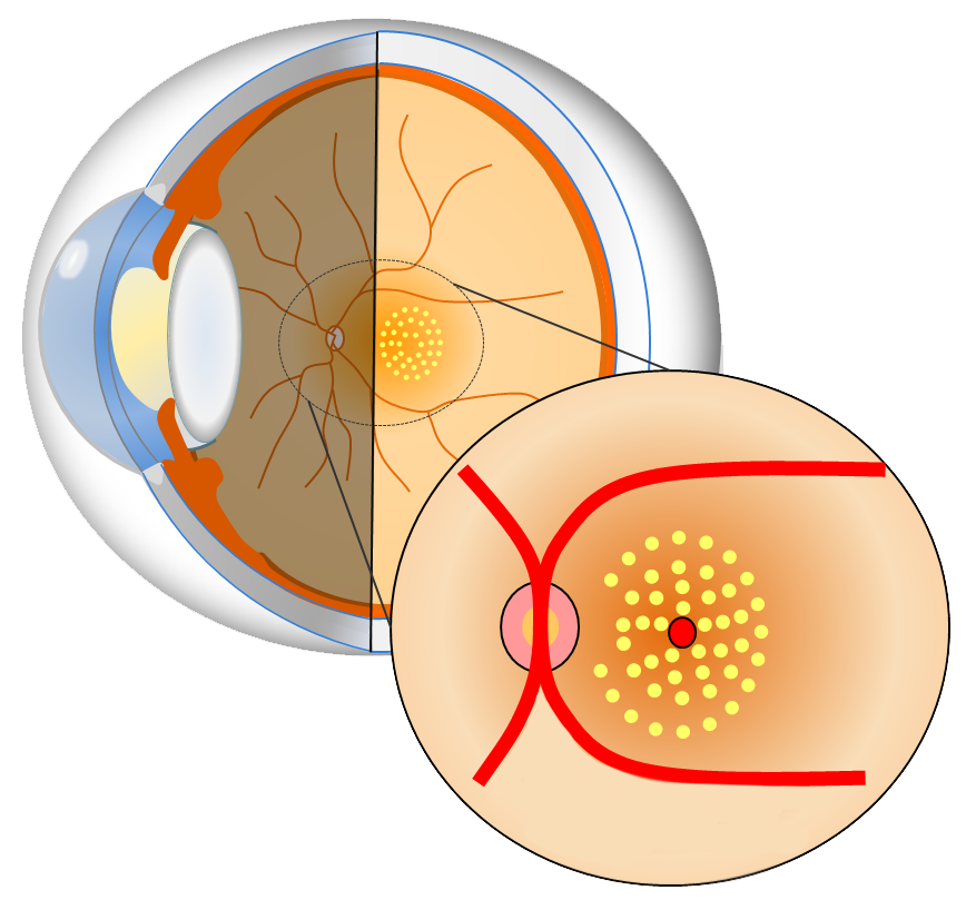 Помутнение хрусталика при катаракте