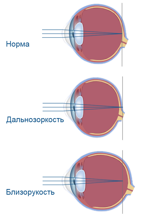 Ухудшение зрения: близорукость и дальнозоркость